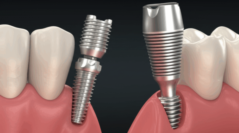Are There Screwless Dental Implants Understanding Your Options