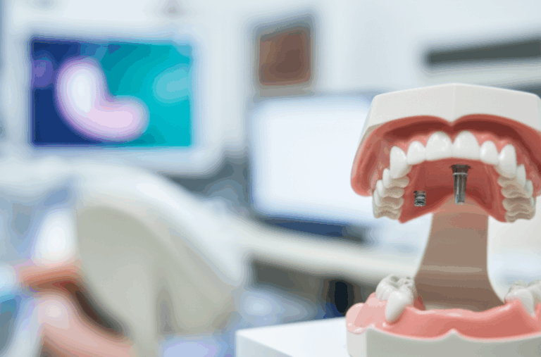 Dental Implants Cost in California My Comprehensive Guide 2024