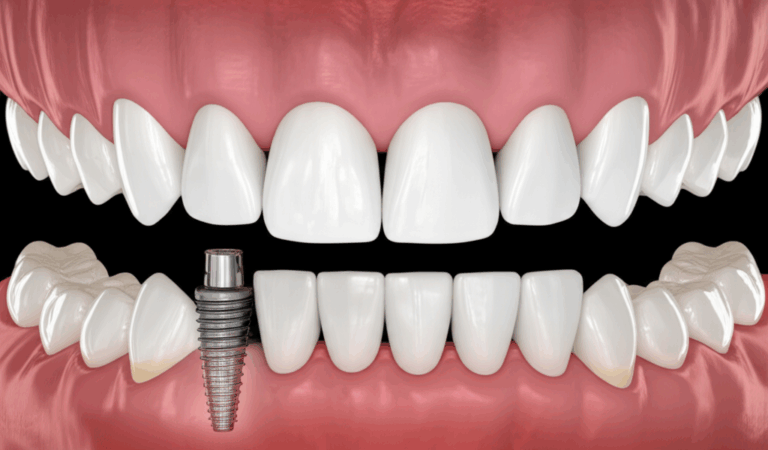 Dental Implants My Honest Journey Through the Pros and Cons