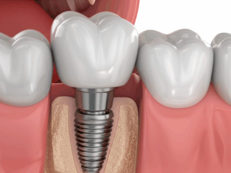 Do Dental Implants Get Cavities My Personal Guide to Implant Health and Longevity