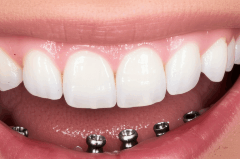 Heal Faster After Dental Implants Your Essential Guide to a Smooth Recovery