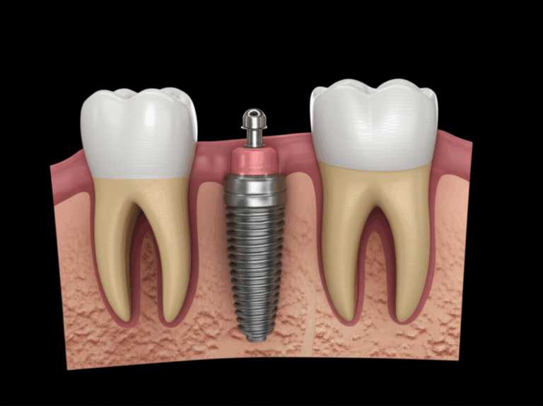 How Many Parts to a Dental Implant The Three Essential Components Explained
