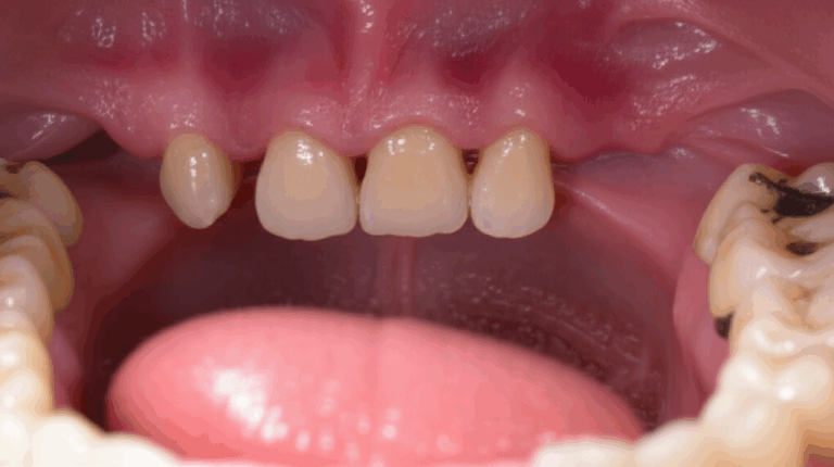 Not Enough Jaw Bone for Dental Implants Your Options Solutions