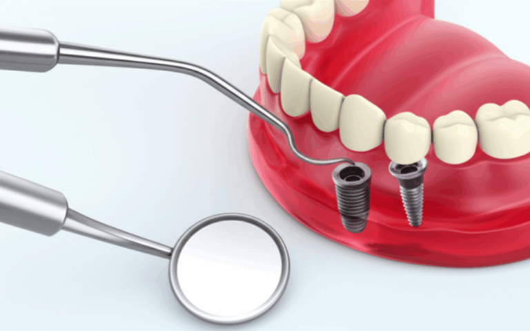 The Complete Guide to the Dental Implant Process Step by Step
