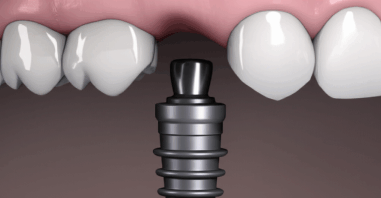 What Are the Signs of a Failing Dental Implant Recognizing Complications Early