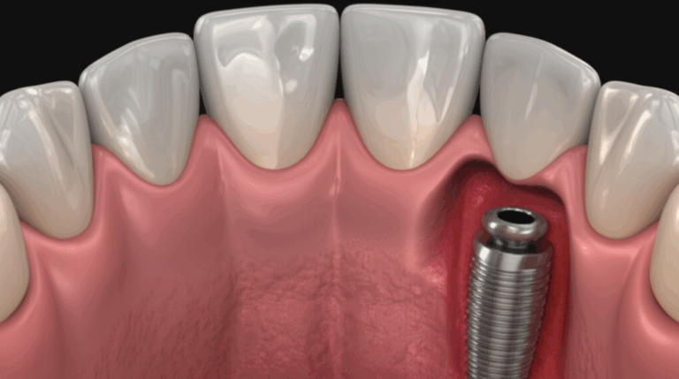 What Can Go Wrong With Dental Implants Understanding Potential Risks and Complications