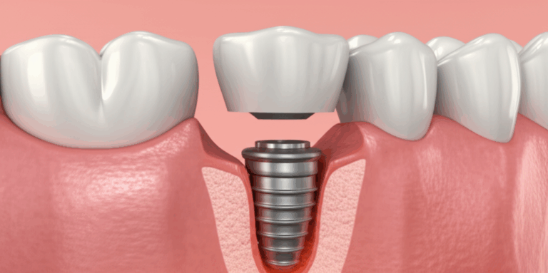 What Causes Bone Loss Around Dental Implants My Complete Guide From First Hand Experience