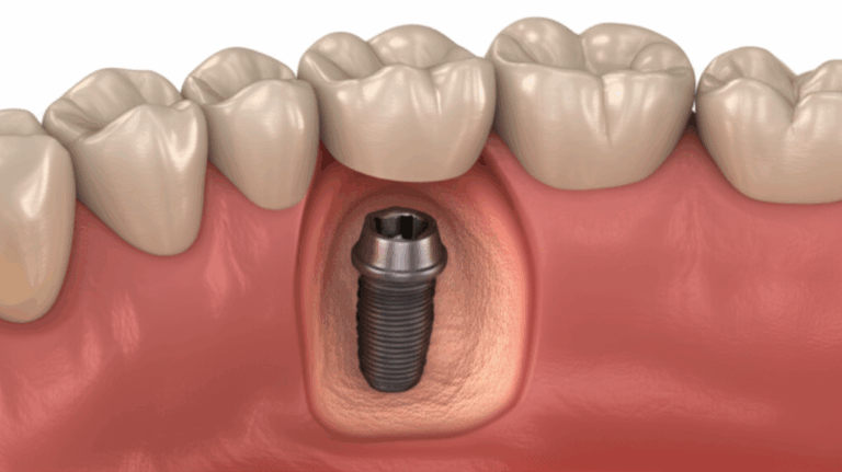 What Happens If a Dental Implant Breaks Your Guide to Symptoms Causes Solutions