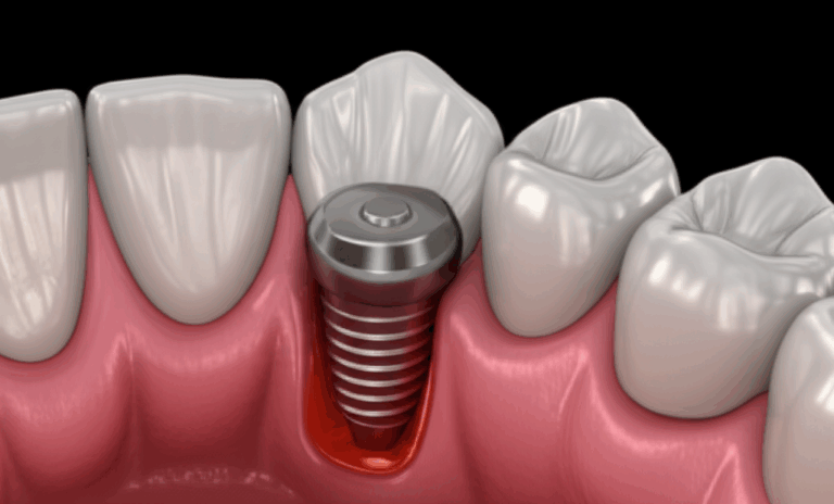 What Happens If a Dental Implant Gets Infected Symptoms Risks and Treatment