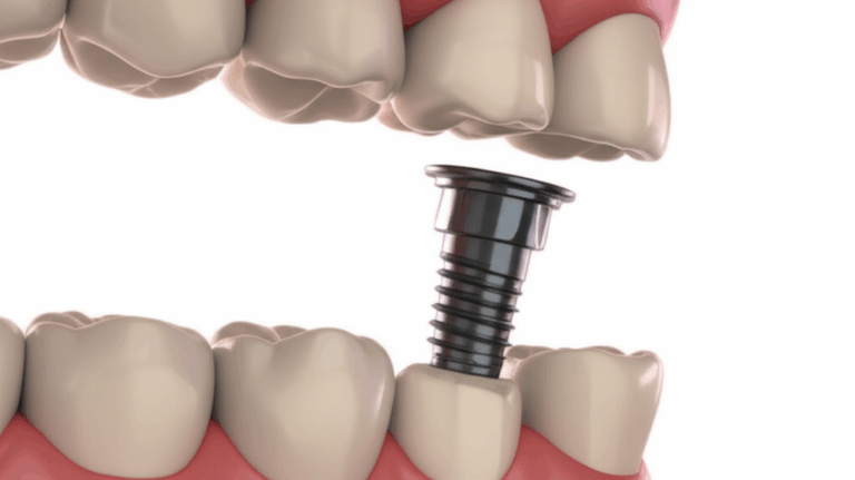 What Holds Dental Implants in Place The Science of Stability and Long Term Success
