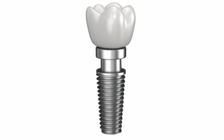 What Is Involved in a Dental Implant A Complete Step By Step Guide