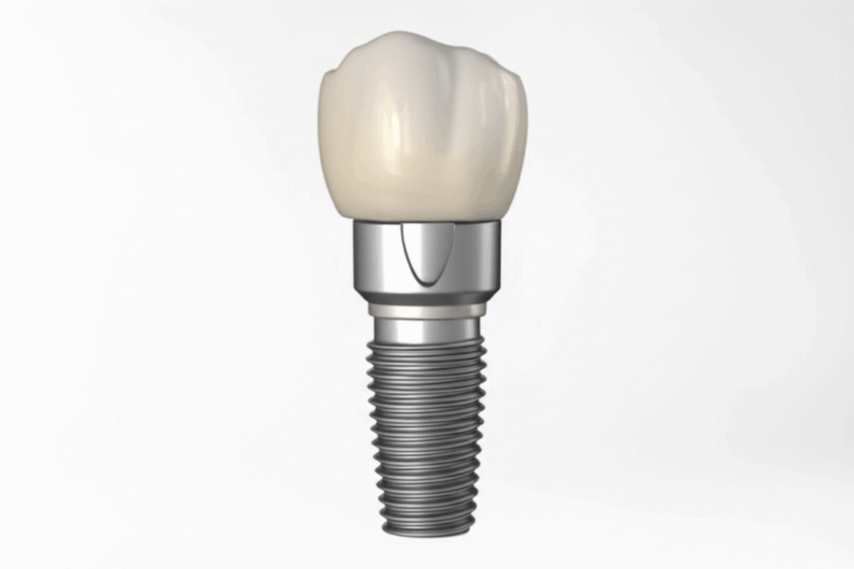 What Is a Dental Implant Abutment My First Hand Experience and Complete Guide