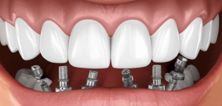 What Is an Arch in Dental Implants Your Complete Guide to Full Arch Restorations