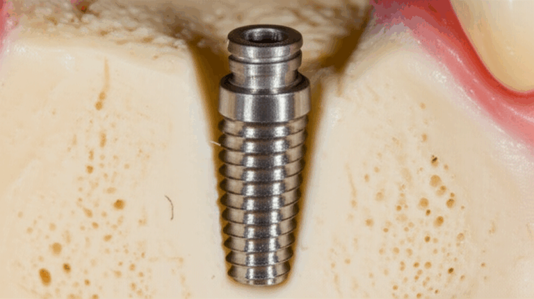 What a Dental Implant Looks Like Before the Crown A Visual Guide to the Healing Stages