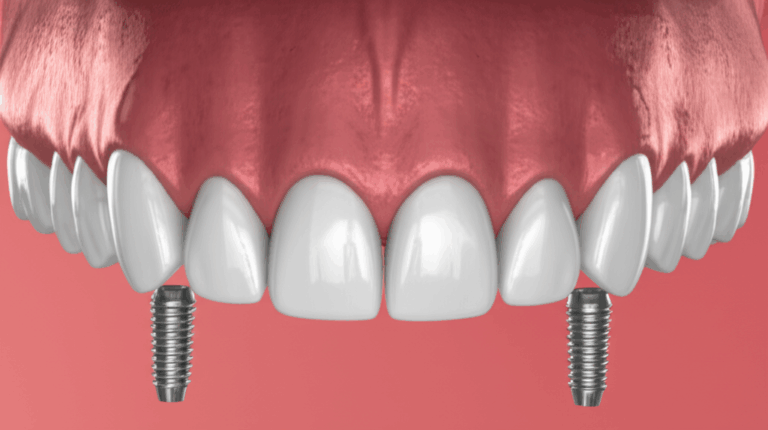 What is a Full Arch Dental Implant My First Hand Guide to Permanent Teeth Replacement