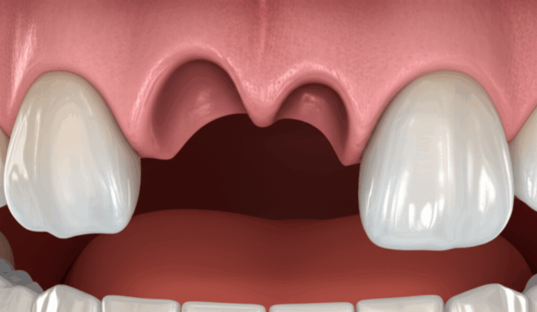 When Are Dental Implants Medically Necessary Understanding Criteria Benefits and Coverage